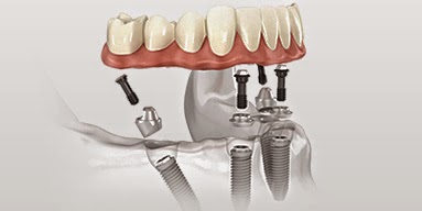 implantes dentários