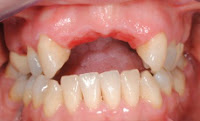 implante dentário