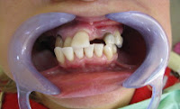 implante dentário