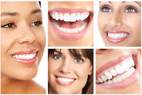 implantes de dentes