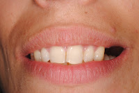 Implantes dentários em Lisboa