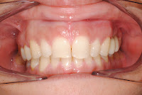 Implantes dentários em Lisboa