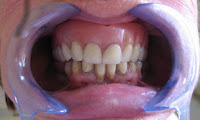 implante dentário
