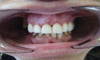 implante dentário