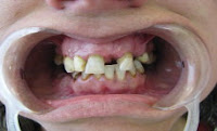 implante dentário