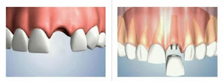 implantes de dentes