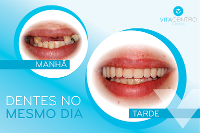 implantes carga imediata