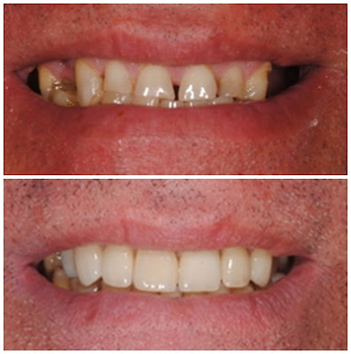 coroas sobre dente